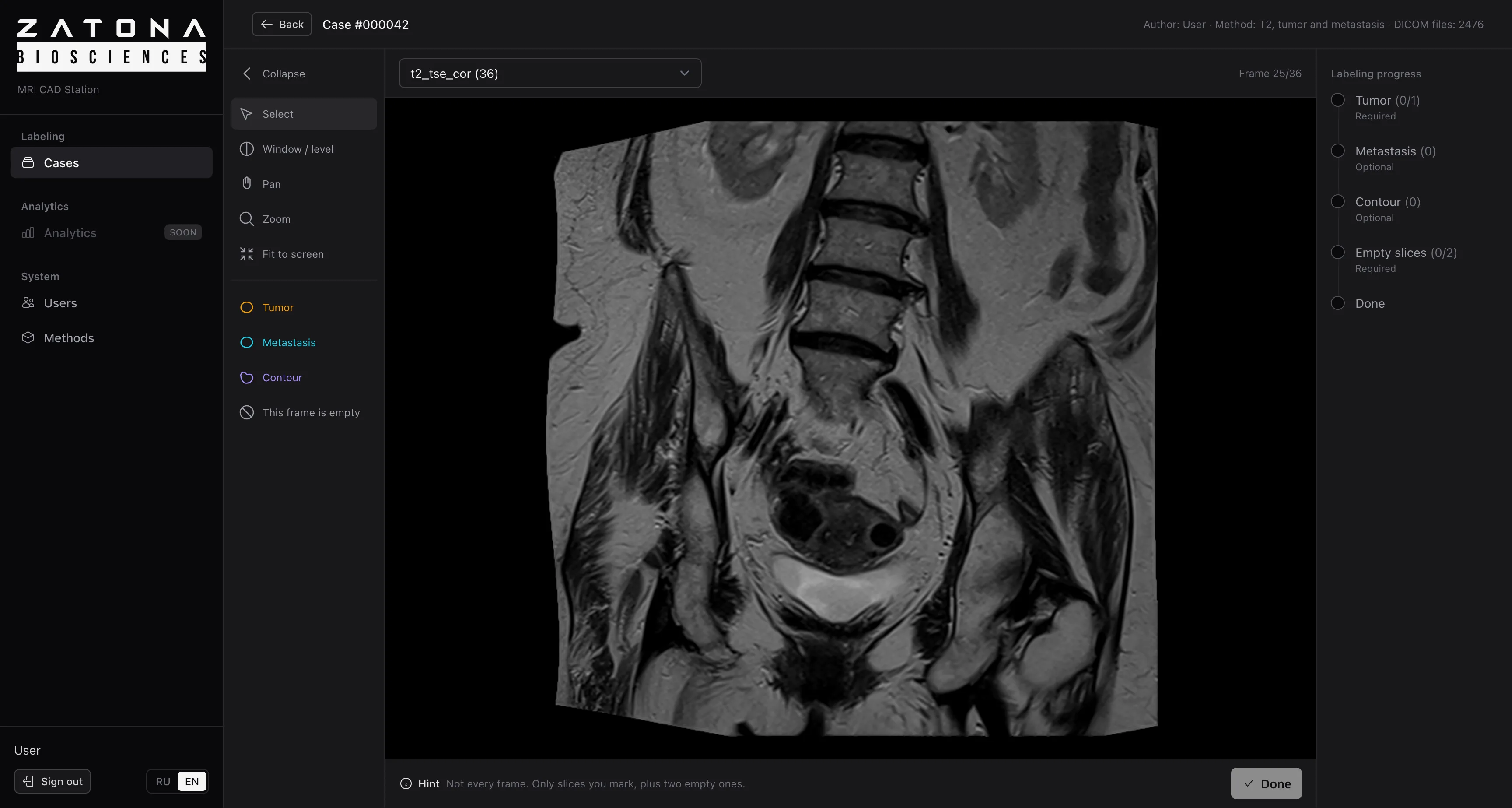 MRI CAD Station: a coronal T2 series of the pelvis open for labelling. Tools on the left: tumour, metastasis, contour, empty slice. Labelling progress on the right.